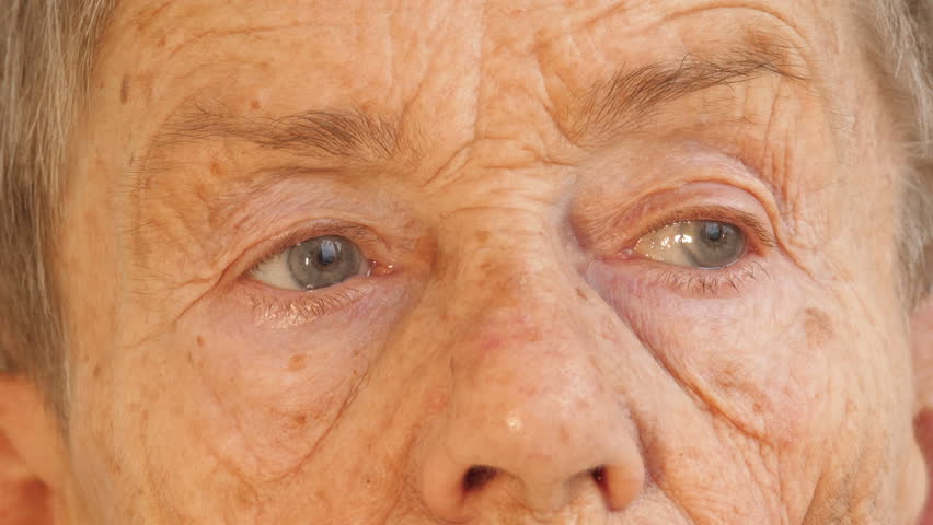 Центральная гетерохромия карих глаз. Колобома радужной оболочки глаза. Выцвели глаза это. Смешанный цвет глаз. Цвет глаз.