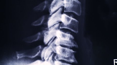 Neck spine MRI Scan or X-Ray video toned. Focus on roentgen and out of focus to blurred creation