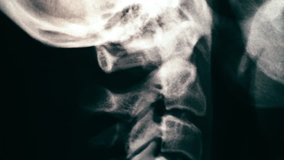Neck spine MRI Scan or X-Ray video toned. Vertical mouvment of shot from up to down