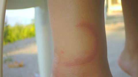 Pelagia Noctiluca jellyfish bite wound on child's leg on Corinthian Gulf of Ionian Sea Mediterranean.