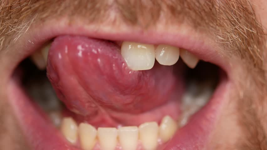 Close-up of teeth. A man shows his denture on two teeth. | Shutterstock HD Video #33853468
