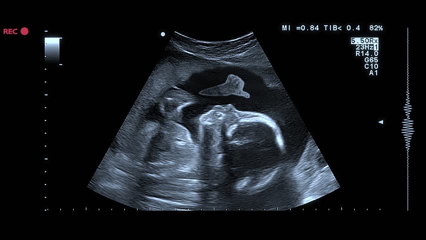 Medical sonography display prenatal test, ultrasonography image, ultrasound baby health care, science, positive pregnancy test, Fetus silhouette in mother womb, diagnostic sonography, intrauterine. Royalty-Free Stock Footage #3397466495