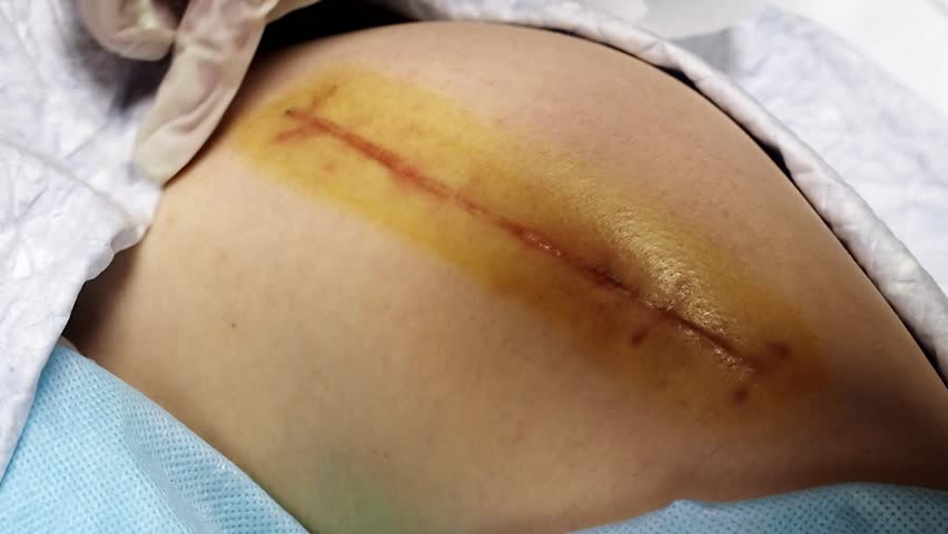 Top view of a suture on the thigh of a lying man, what the suture looks like 2 months after a total hip replacement, close up. Applying a sterile plaster to the treated seam Royalty-Free Stock Footage #3398509051