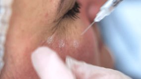 Beautician doctor makes botox injection in the cheekbone of young beautiful woman. Extreme close up 4k shot - Powered by Shutterstock - Get 15% off with code: PIKWIZARD15