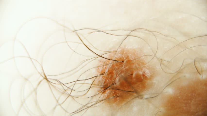 Hair Growing Out Of Skin Stock Footage Video 100 Royalty Free 34048210 Shutterstock