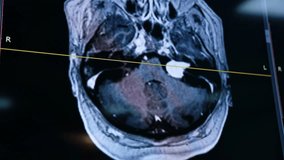 Head MRI scan on the monitor in surgical room. Close up. Patient's film of brain prepared for surgery. - Powered by Shutterstock - Get 15% off with code: PIKWIZARD15
