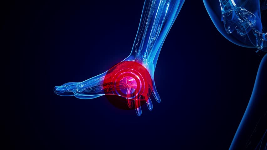 4K abstract animation of plantar fascitis