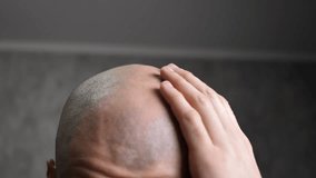 A bald man strokes the skin on his bald head with his hand. Macro video of the receding hairline of a balding man. The concept of hair diseases and hair loss in men.