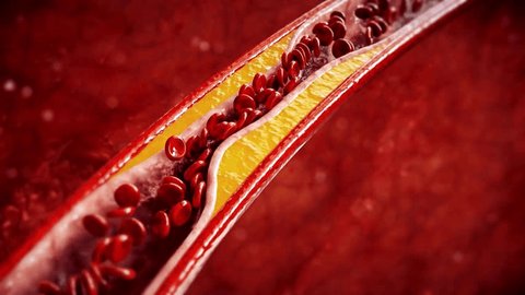 Cholesterol block blood cell in artery, Blood clot inside a blood vessel of the heart. Coronary artery disease concept. Heart attack, atherosclerosis plaque build up from cholesterol from cholesterol.の動画素材