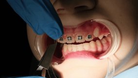 Vertical video. A dentist puts braces on the teeth of a young girl child. Bracket positioning using reverse tweezers. Close-up.