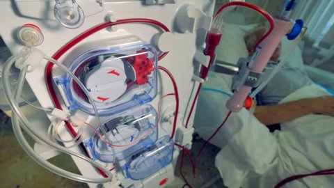 Patient during hemodialysis procedure. Modern dialysis machines making blood purification.