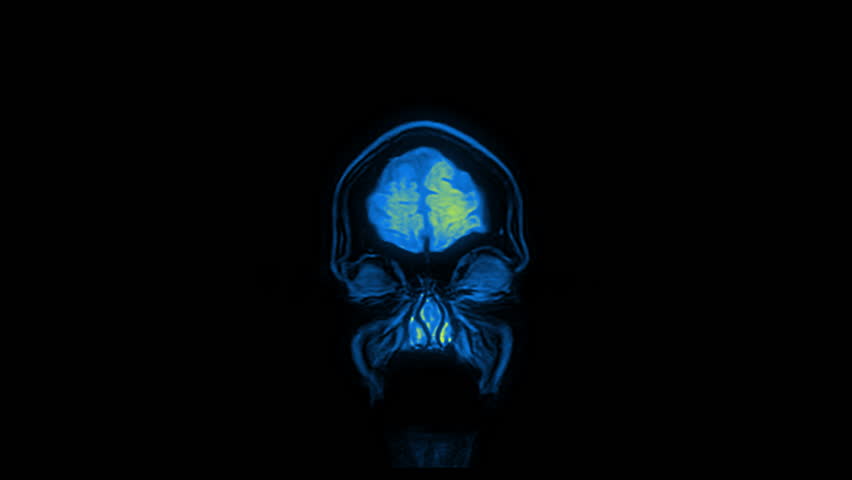 Computed medical tomography MRI upscaled scan of healthy young female head. Front view. Discrete slices. Red, yellow, blue on black background. (av44004c) Royalty-Free Stock Footage #34270684