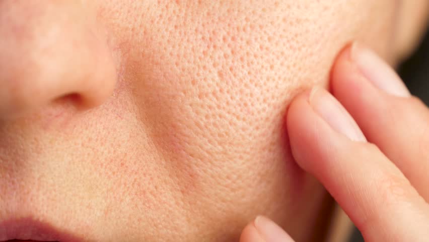 Close-up of part of the face. facial skin with enlarged pores, problem skin. Cosmetology. texture, health. illness skin Royalty-Free Stock Footage #3427928145