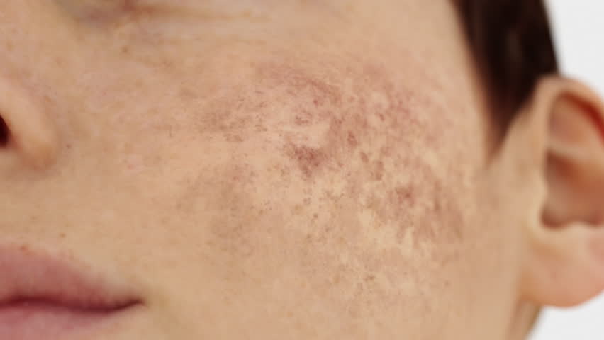 Laser treatment for skin problems. Laser removes freckles and repairs the skin. Royalty-Free Stock Footage #3431407613