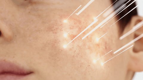 Laser treatment for skin problems. Laser removes freckles and repairs the skin. 库存视频