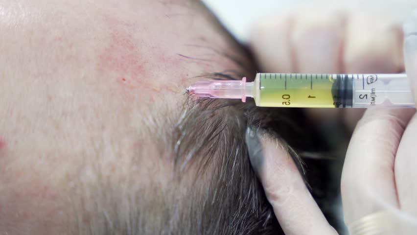 Macro shot of Hair mesotherapy procedure in the modern cosmetology clinic, plasma injectiions. Middle aged male patient prp procedure for hair regrowth Royalty-Free Stock Footage #3432272585