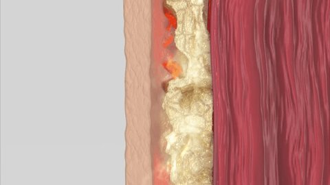 3D cross section show fat burning under the skin Stock-video
