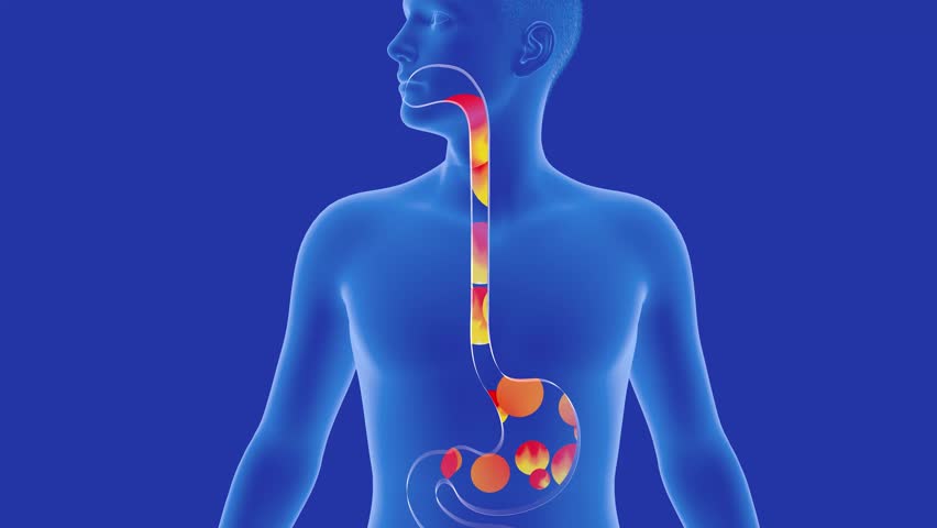 Anatomical 3D animation of the stomach and esophagus with reflux to the mouth. With ardor and circles of fire. Digestive system and transparent human figure on blue background.