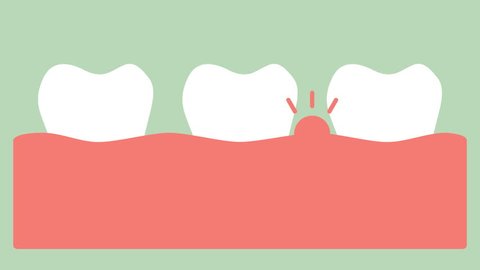 gingivitis or gum disease, gum inflammation before periodontal disease - dental cartoon vector flat style render 2d footage animation, in 4K and UHD ultra high definition video format 3840x2160