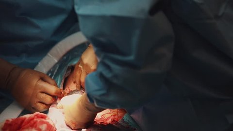 Close up cesarean section birth surgery. doctors hands wearing surgical gloves operating team protective clothing performing surgery using sterilized equipment during caesarean birth surgery operation