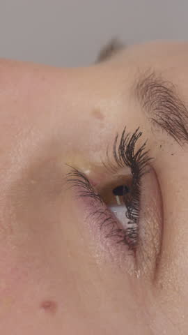 CLOSE UP: Adult Caucasian female drops eye medicine into her dry left eye. Unrecognizable young woman applies eyedrops to her irritated eye. Detailed shot of woman's eye during eyedrop application.