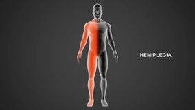 Hemiplegia type paralysis 3d rendered video clip