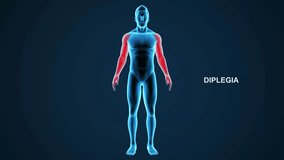 Diplegia type paralysis 3d rendered video clip
