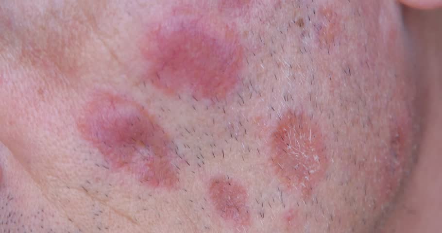 A case of cutaneous sarcoidosis on the face of a man, close up view Royalty-Free Stock Footage #3453009903