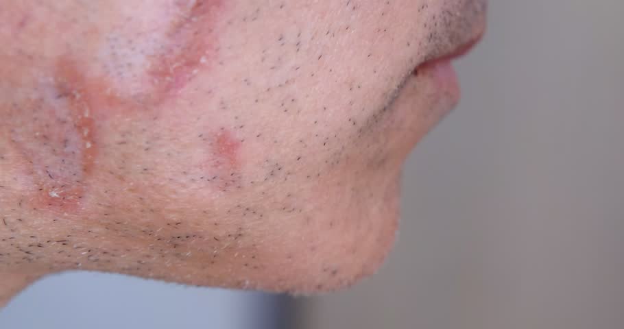 A case of cutaneous sarcoidosis on the face of a man, close up view Royalty-Free Stock Footage #3453010105
