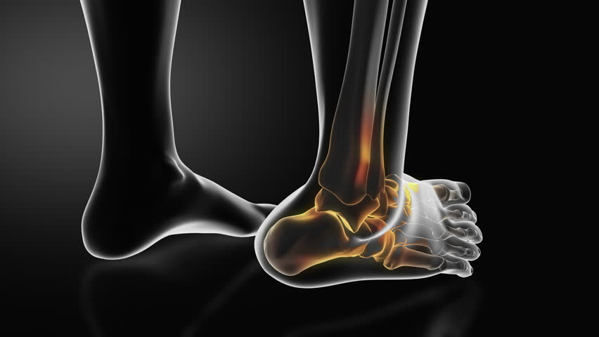 Ankle injury with dislocation and sprains