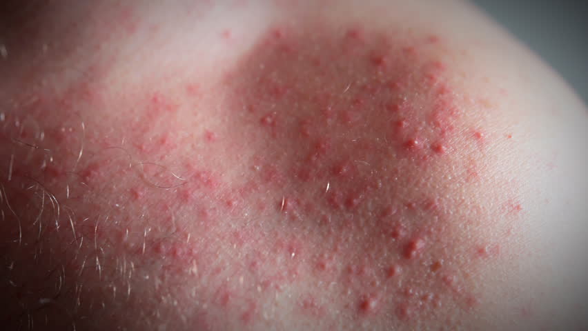 Close-up shot of skin rashes and pimples on human shoulder, red itchy spots being an allergy reaction on food, medicine, stress, imbalanced hormones, cancer disease, some chemicals or unhygienic Royalty-Free Stock Footage #3455433253