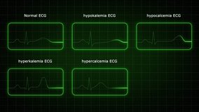 Types of (ECG) Electrocardiogram 3d rendered video clip
