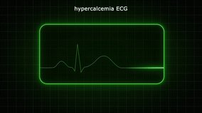 Hypercalcemia (ECG) Electrocardiogram 3d rendered video clip