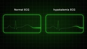 Normal and hypokalemia Electrocardiogram 3d rendered video clip