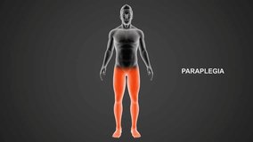 Paraplegia type paralysis 3d rendered video clip