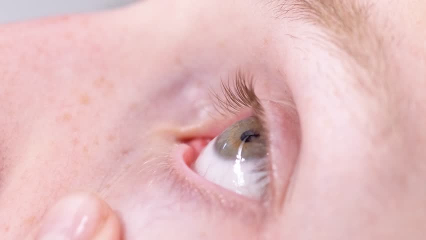 Closeup young man drops eye drops install lenses, moisturizing, using medical eyes drops suffering from dry eyes syndrome or curing ophthalmology disease, lady having blurred eyesight, treating eyes Royalty-Free Stock Footage #3467828251