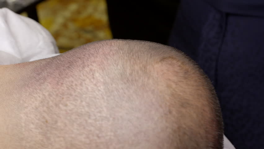 Close up shots of Scalp micropigmentation, also known as a hair tattoo, can cover bald spots or thinning hair without surgery Royalty-Free Stock Footage #3469142513