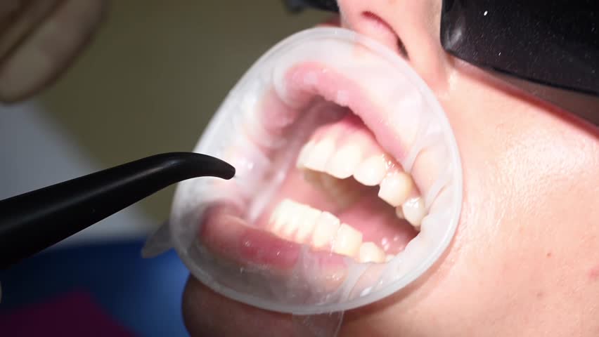 Dental Extreme Close up Macro Video. Dental Cleaning process in patient mouth. Clean teeth with water jet and saliva ejector. Concept of professional dental hygiene. 4k 120 fps slow motion raw footage Royalty-Free Stock Footage #3472079821