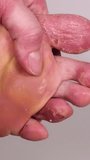 Woman scratches her toes with her finger. Huge wound on female foot after several confluent blisters of eczema. Acute psoriasis, chemical irritation, allergic reaction, dermatological disease on foot.
