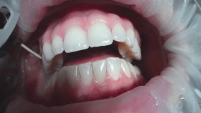 Professional dentist conducts a thorough check-up of woman teeth, inspecting for cavities, gum health, and overall oral hygiene. 4k cinematic raw slow motion video