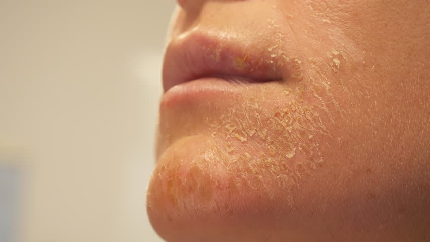 CLOSE UP, DOF: Damaged flaky skin on the face of an unrecognizable young woman. Harmful consequences due to carelessness in summer sunbathing, which can gradually lead to development of skin cancer.
