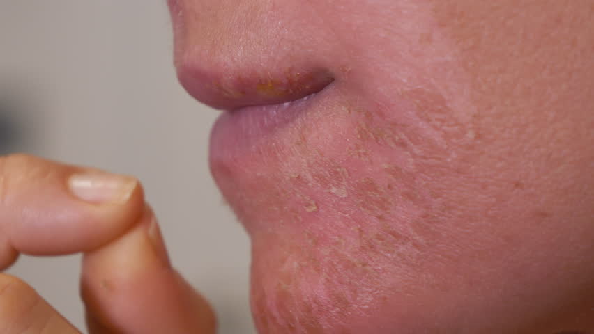 CLOSE UP, DOF: Lady with dermatitis scratches and peels of flaky skin from her face. Young woman with a damaged epidermis suffers from itchy and irritated red skin caused by an allergic reaction.