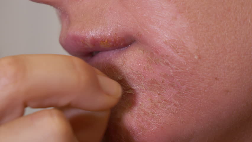 CLOSE UP, DOF: Young woman peels off dead and dry skin from her sunburnt face. Irritated skin of a lady who was overdoing her tanning under strong sun and suffered severe and harmful facial burns.