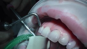 Detailed view of a persons teeth being examined and treated with dental tools. 4k cinematic raw slow motion video