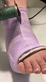 Man injured his leg, his leg is in a cast. Man is awaiting surgery to remove the plaster. Healthcare worker is carefully cutting through a purple plaster cast on a patients foot with an oscillating