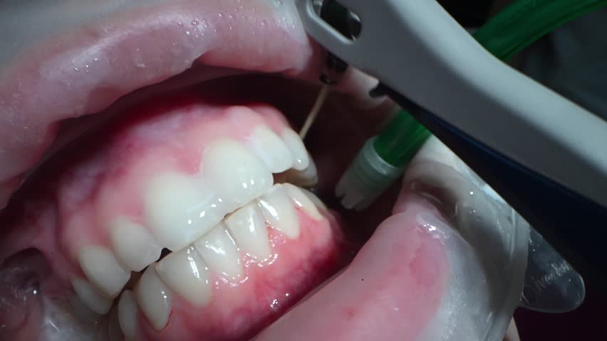 Dental Extreme Close up Macro Video. Dental Cleaning process in patient mouth. Clean teeth with water jet and saliva ejector. Concept of professional dental hygiene. 4k 120 fps slow motion raw footage Royalty-Free Stock Footage #3486224313