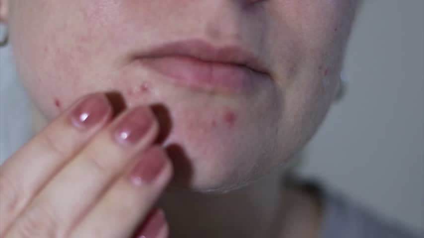 Close up of a young woman applying face creme on red problematic acne skin Royalty-Free Stock Footage #3488054529