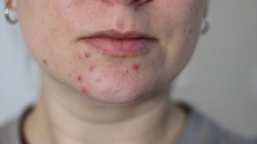 Close up of a young woman applying face creme on red problematic acne skin Royalty-Free Stock Footage #3488054569