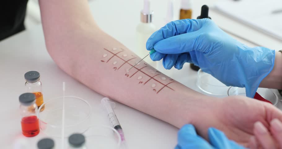 Skin prick test for allergies in the clinic. Modern methods of diagnosing allergies