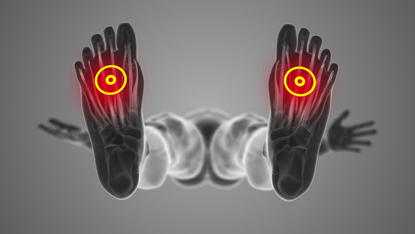 Plantar fascia discomfort in both feet that trigger pain
